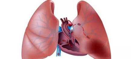 Un anevrism al arterei pulmonare este ceea ce este, simptome