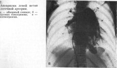 Anevrismul descrierii arterei pulmonare a bolii, simptome, recomandări de tratament