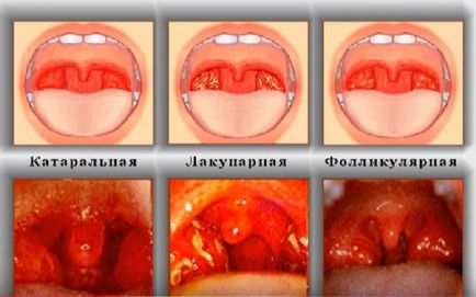 Angina la copii - cauzele, semnele și simptomele, tratamentul anginei la un copil