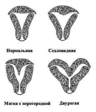 Аномалії розвитку матки - опис поширених вад