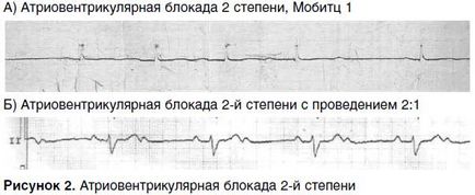 Атріовентрикулярна блокада серця 1, 2, 3 ступеня - симптоми і лікування