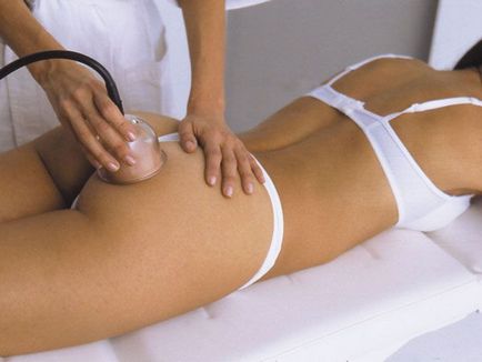 Баночний масаж від целюліту в домашніх умовах техніка, відгуки, банки для масажу