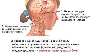 Basilaris migrén okai, a tünetek, a kezelés, a diagnózis