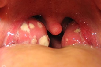 Білі точки на мигдалинах у дитини - плями в горлі у дітей