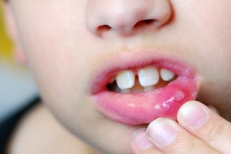Білі точки на мигдалинах у дитини - плями в горлі у дітей