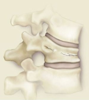 Kümmel betegség (aszeptikus nekrózis, traumás spondylitis) - mi ez a betegség