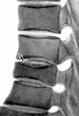 Kümmel betegség (aszeptikus nekrózis, traumás spondylitis) - mi ez a betegség