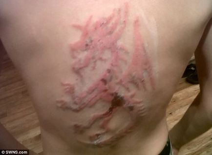 Frații au primit arsuri teribile de la un tatuaj henna temporar făcut în Egipt, umkra
