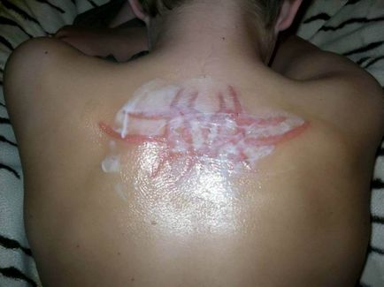 Brothers kapott szörnyű égési sérüléseket ideiglenes henna tetoválás, Égyiptomban, umkra