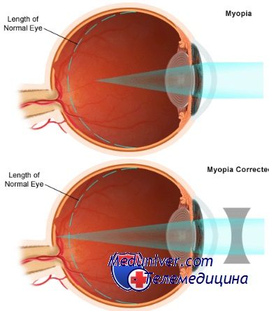 Чим небезпечна висока ступінь короткозорості здоров'я очей