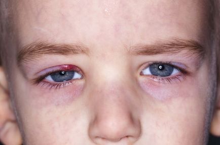 Ce trebuie făcut dacă un copil are orz pe tratamentul și prevenirea ochilor