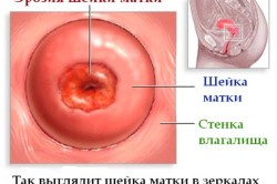 Що робити на шийці матки прищик