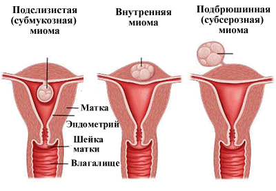 Ce este fibromul uterin și pentru ce este periculos, ceea ce este
