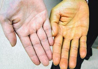 Cirrhosis (fotó és videó) (cirrhosis) Májcirrózis (fotó és videó)