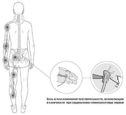 Degeneráció a lemez zavarás