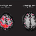 Efectele leziunilor cerebrale masive la alcoolici, blog sobru