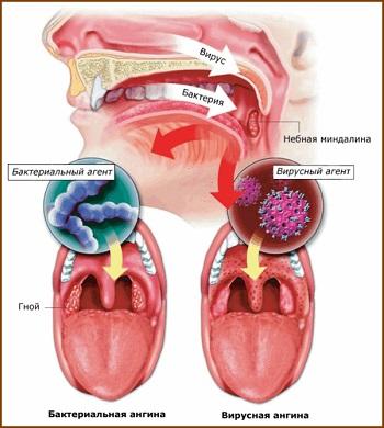 Ефективне лікування ангіни - блог Галини Лук'янової