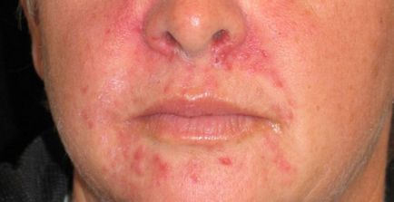 Eczemă, tratamentul erupțiilor cutanate cu medicamente populare