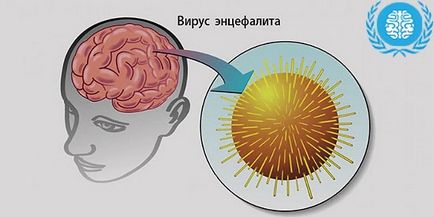 Енцефаліт головного мозку