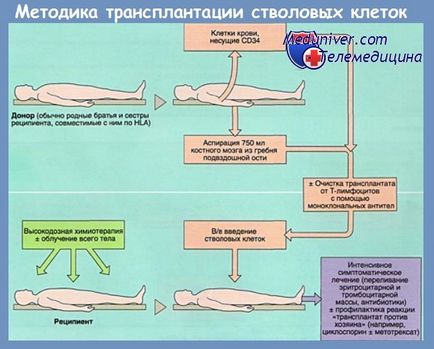 Etapele transplantului de celule stem hematopoietice (mielotransplant)