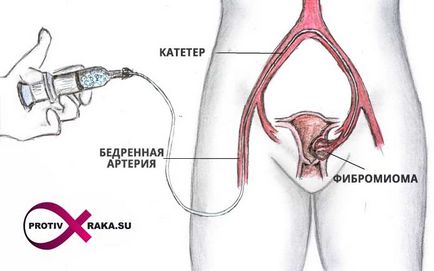 Fibromiomul simptomelor uterine, semnelor, tratamentului, diagnosticului