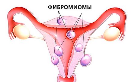 Fibromiomul simptomelor uterine, semnelor, tratamentului, diagnosticului