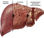 Fotografii ale manifestărilor de ciroză hepatică