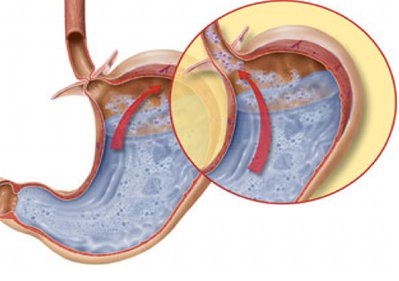 Boala de reflux gastroesofagian (reflux-esofagită)