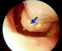 Hipertrófiás rhinitis - okai, tünetei, diagnózisa és kezelése