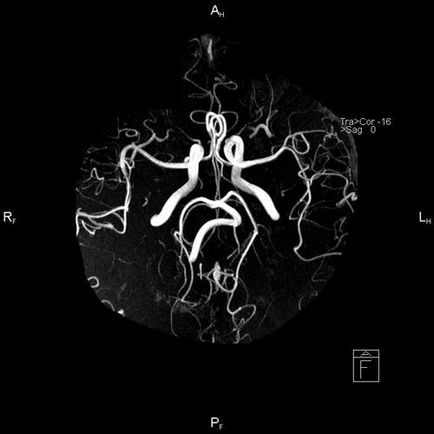Hipoplazia arterei vertebrale (dreapta, stânga) că acest tratament, consecințele