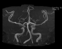 Hipoplazia arterei vertebrale (dreapta, stânga) că acest tratament, consecințele