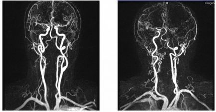 Hipoplazia arterei vertebrale (dreapta, stânga) că acest tratament, consecințele