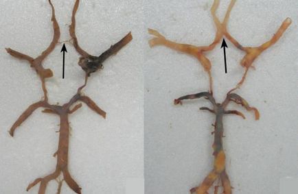 Hipoplazia arterei vertebrale (dreapta, stânga) că acest tratament, consecințele