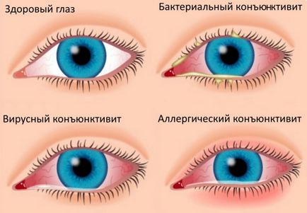 Picături de ochi de la conjunctivită pentru tratamentul copiilor și nu numai