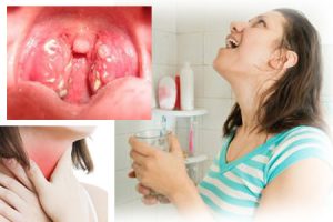 Purulente tratamentul gâtului pentru copii și adulți la domiciliu