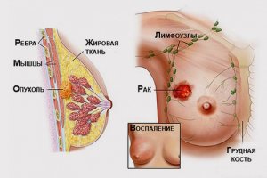 Гормонотерапія при раку молочної залози види і препарати