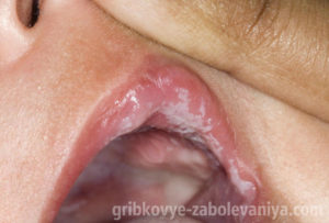 Ciuperca in gura in cauza nou-nascut, simptome, tratament