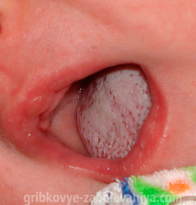 Ciuperca in gura in cauza nou-nascut, simptome, tratament