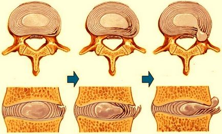 Hernia gâtului - tratăm coloana vertebrală