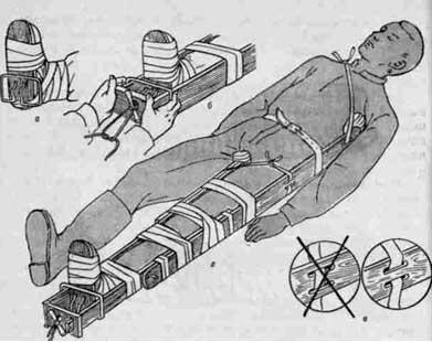 Іммобілізація нижньої кінцівки транспортними шинами - транспортна іммобілізація - невідкладна
