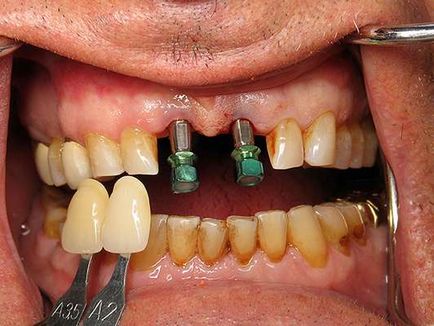 Az implantáció tettem videók implantátumok lehet periodontitis és a fogágybetegség - „minden részletet”