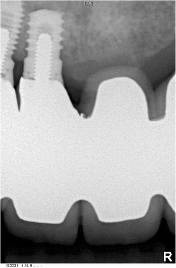 Az implantáció az orrüreg egy ritka hiba iatrogén beavatkozás - Implantológia - hírek