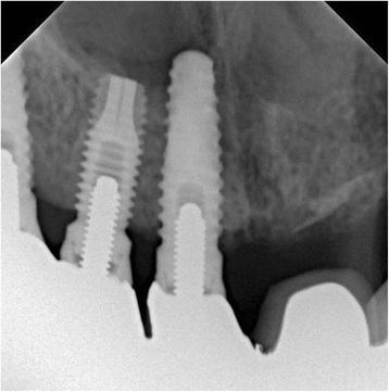 Az implantáció az orrüreg egy ritka hiba iatrogén beavatkozás - Implantológia - hírek