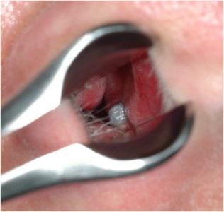 Az implantáció az orrüreg egy ritka hiba iatrogén beavatkozás - Implantológia - hírek