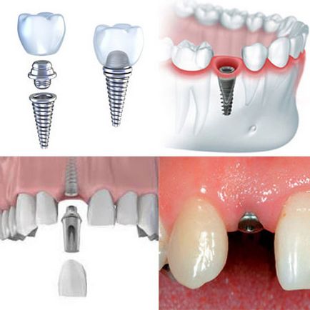 Імплантація зубів види і ціни