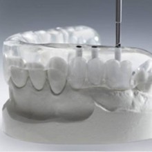 Імплантація зубів види і ціни