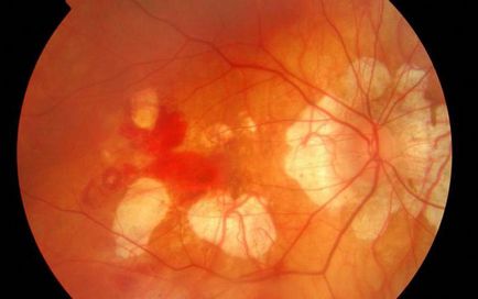 Antagonistul mecanismului anhidrazei carbonice a picăturilor oculare în glaucom