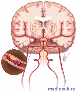 Ischemic accident cerebral, simptome, tratament, cauze