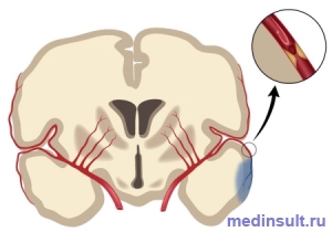 Ischemic accident cerebral, simptome, tratament, cauze