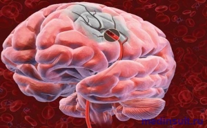 Ішемічний інсульт головного мозку симптоми, лікування, причини